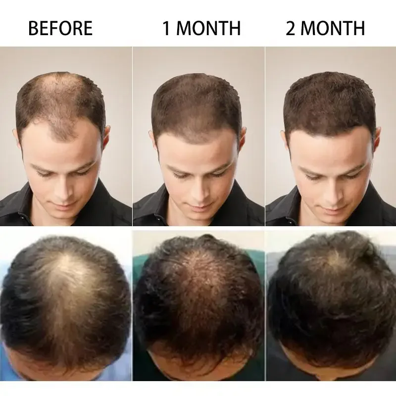 Crescimento do cabelo gengibre - Ingrown Hair Serum avaliação e preço